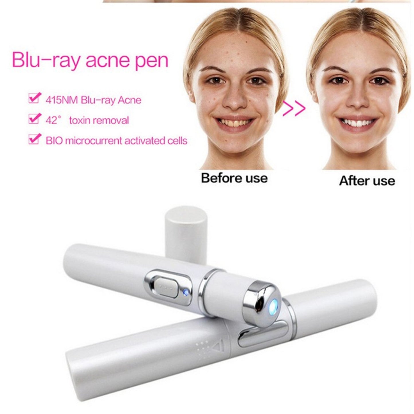 Blue Light Therapy Acne Laser Pen - Soft Scar & Wrinkle Removal Treatment Device