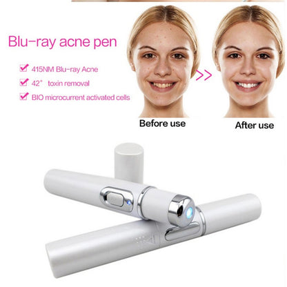Blue Light Therapy Acne Laser Pen - Soft Scar & Wrinkle Removal Treatment Device